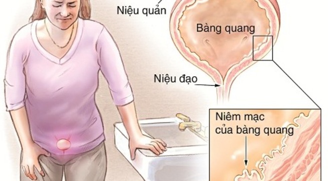 Biến chứng viêm bàng quang có nguy hiểm?