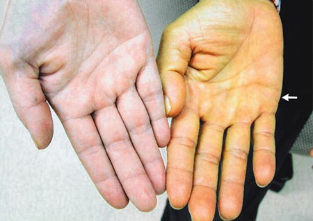 nuoc-tieu-vang-dam-2